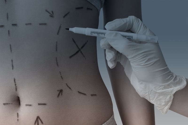 Abdominoplastia