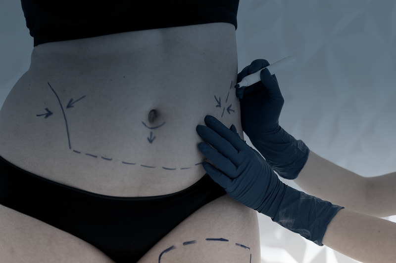 Lipoaspiração