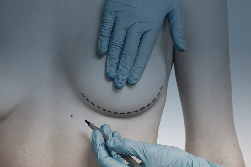 Mamoplastia